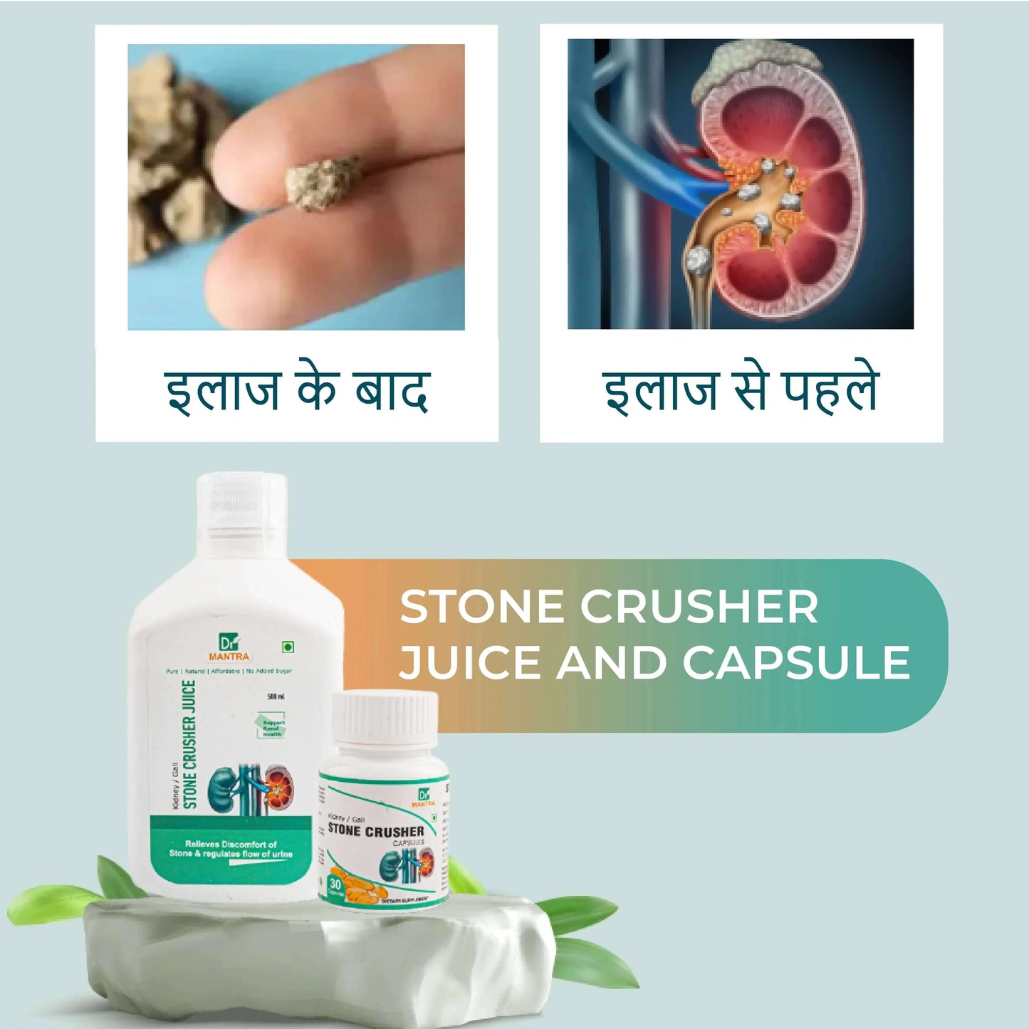 Kidney Stone Crusher Juice (Free Diet Chart & Ayurveda Expert Consultation ) - Dr Mantra