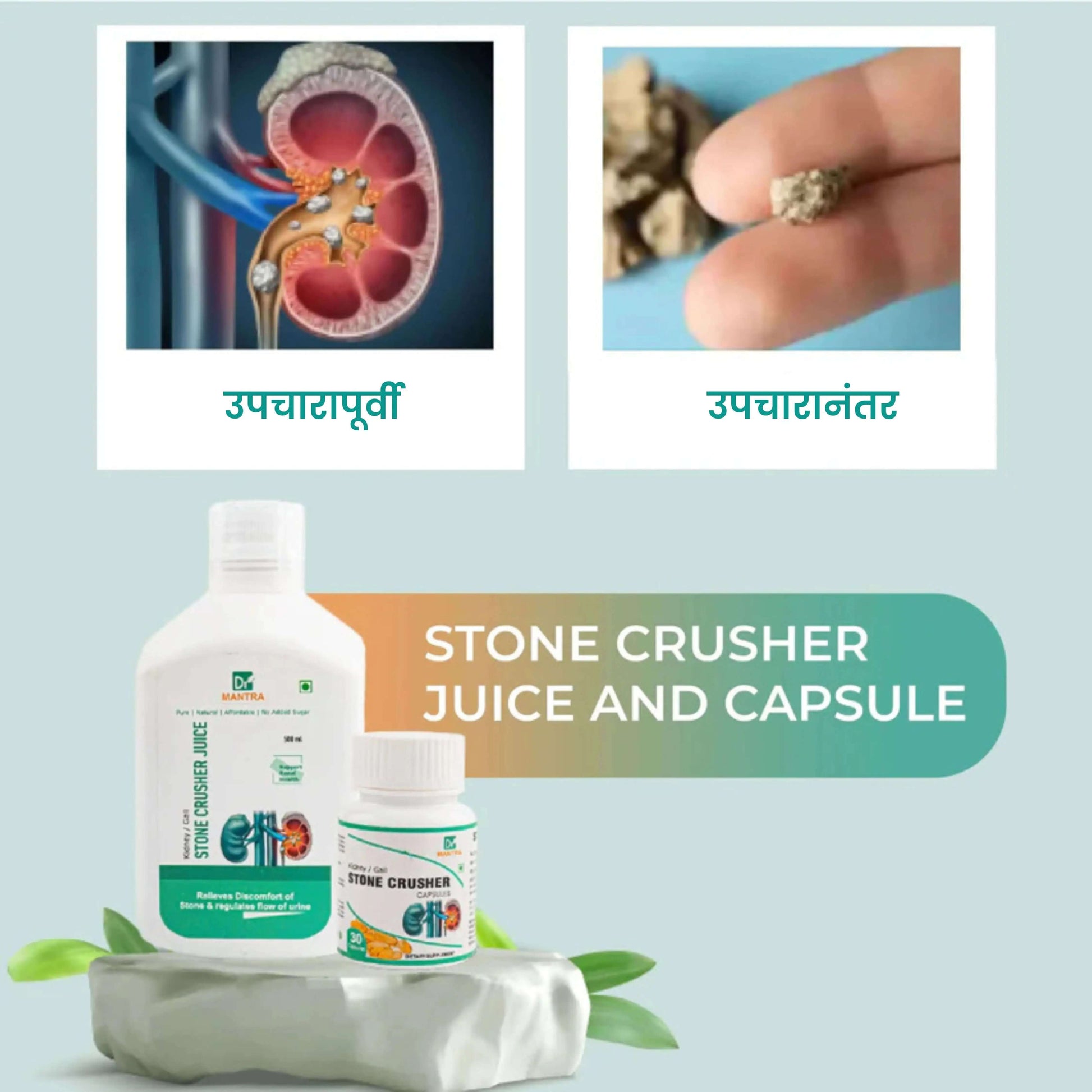 किडनी स्टोन क्रशर ज्यूस (फ्री डायट चार्ट व आयुर्वेदा एक्स्पर्ट कन्सल्टेशन) - Dr Mantra